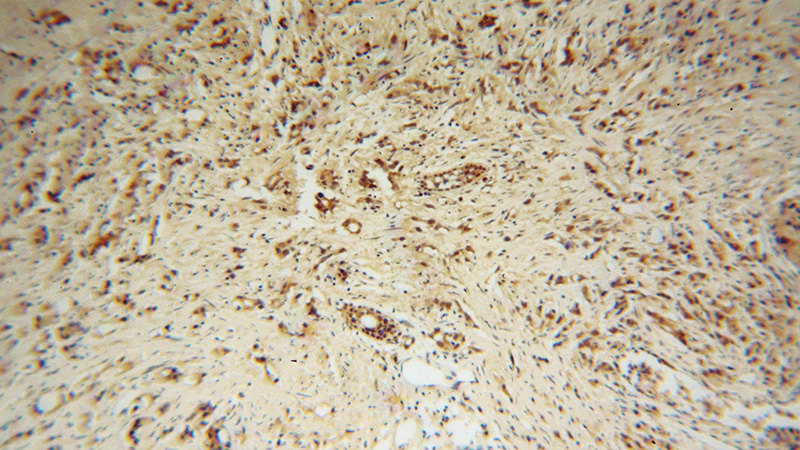Immunohistochemical of paraffin-embedded human gliomas using Catalog No:107774(ADAR1 antibody) at dilution of 1:50 (under 10x lens)