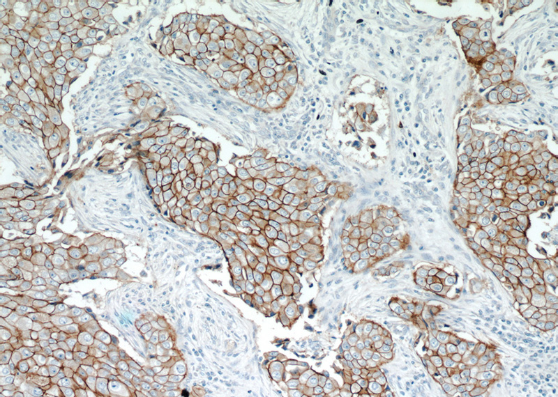 Immunohistochemical of paraffin-embedded human breast cancer using Catalog No:111295(ERBB2,p185-Specific antibody) at dilution of 1:50 (under 10x lens)