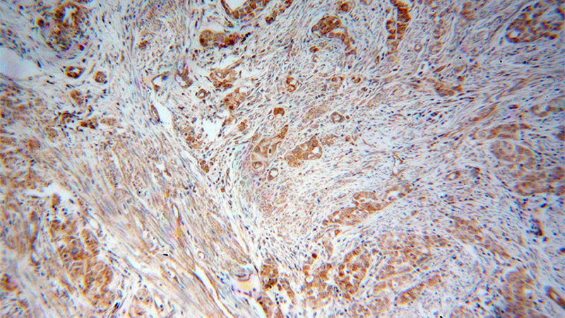 Immunohistochemical of paraffin-embedded human endometrial cancer using Catalog No:112057(KNG1 antibody) at dilution of 1:50 (under 10x lens)
