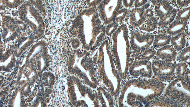 Immunohistochemistry of paraffin-embedded human endometrial cancer tissue slide using Catalog No:107490(PTEN Antibody) at dilution of 1:200 (under 10x lens). heat mediated antigen retrieved with Tris-EDTA buffer(pH9).