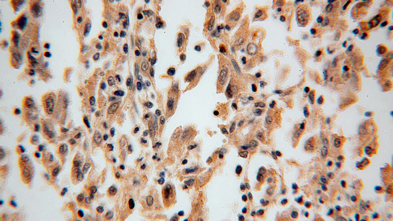 Immunohistochemical of paraffin-embedded human lung cancer using Catalog No:114199(PRKCDBP antibody) at dilution of 1:100 (under 40x lens)