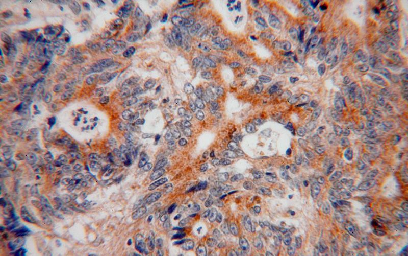 Immunohistochemical of paraffin-embedded human colon cancer using Catalog No:113534(BCAR1 antibody) at dilution of 1:100 (under 40x lens)
