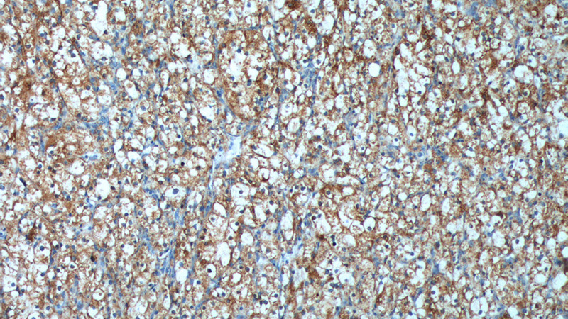Immunohistochemistry of paraffin-embedded human renal cell carcinoma tissue slide using Catalog No:108913(CAMK2A Antibody) at dilution of 1:200 (under 10x lens).