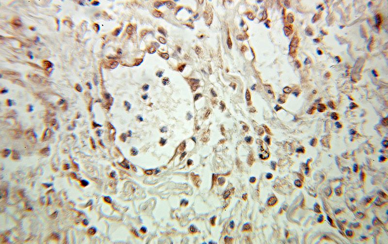 Immunohistochemical of paraffin-embedded human pancreas cancer using Catalog No:112668(MKP-2 antibody) at dilution of 1:100 (under 10x lens)