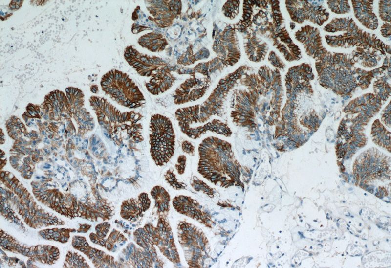 Immunohistochemical of paraffin-embedded human ovary tumor using Catalog No:109811(KRT7-Specific antibody) at dilution of 1:50 (under 10x lens). Heat mediated antigen retrieved with Citric acid buffer, pH6.0