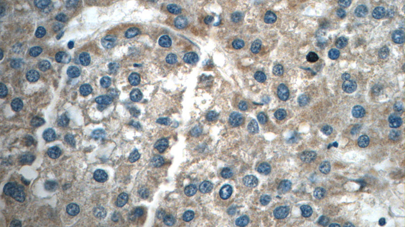 Immunohistochemistry of paraffin-embedded human liver cancer tissue slide using Catalog No:114413(RAB14 Antibody) at dilution of 1:50 (under 40x lens)