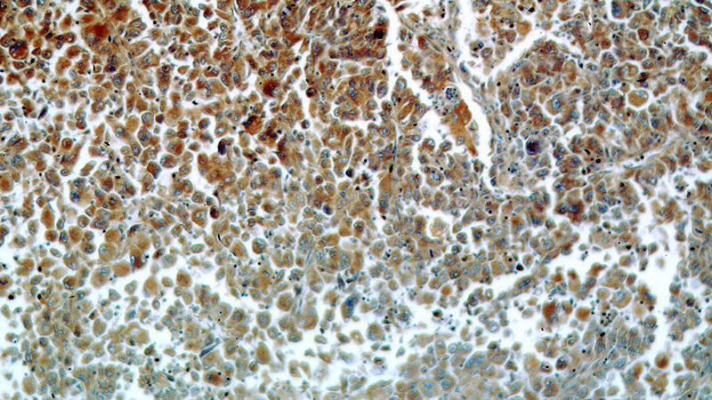 Immunohistochemical of paraffin-embedded human lung cancer using Catalog No:108798(C9orf156 antibody) at dilution of 1:50 (under 10x lens)