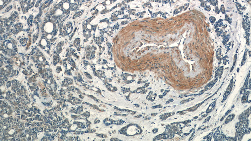 Immunohistochemistry of paraffin-embedded human cervical cancer tissue slide using Catalog No:115864(TBC1D22A Antibody) at dilution of 1:50 (under 10x lens)