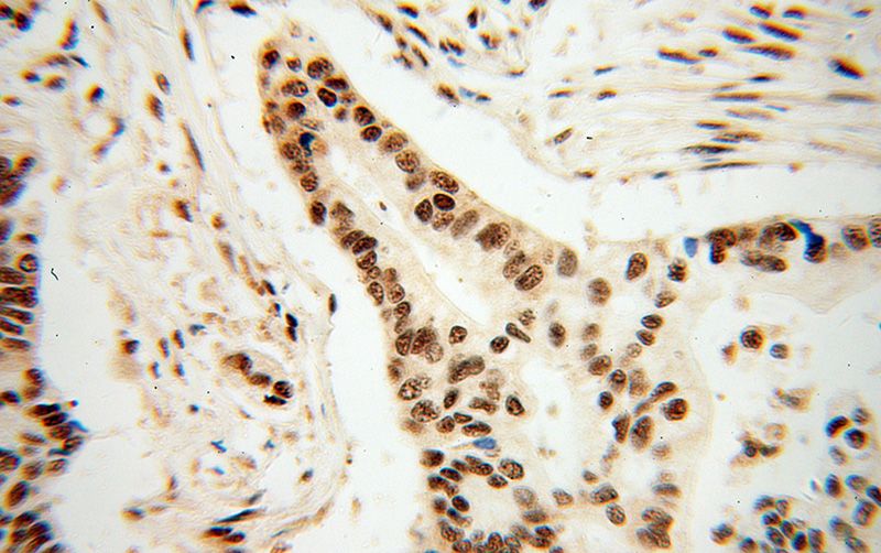 Immunohistochemical of paraffin-embedded human pancreas cancer using Catalog No:109576(CROP antibody) at dilution of 1:50 (under 40x lens)