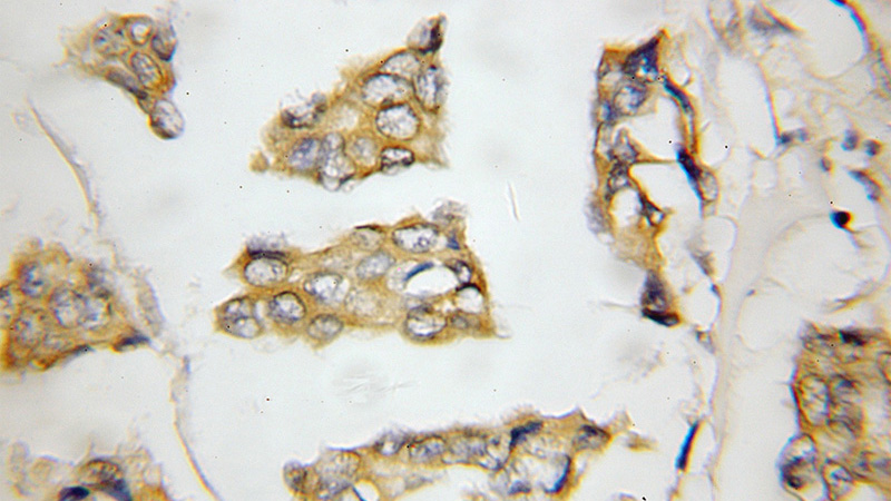 Immunohistochemical of paraffin-embedded human breast cancer using Catalog No:110858(CSE antibody) at dilution of 1:50 (under 10x lens)