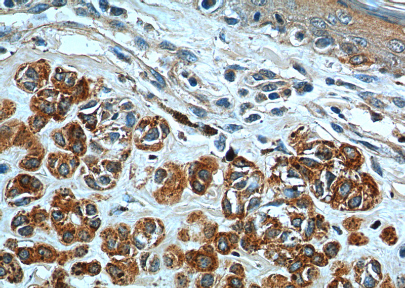 Immunohistochemistry of paraffin-embedded human malignant melanoma tissue slide using Catalog No:107426(MLANA Antibody) at dilution of 1:200 (under 40x lens).