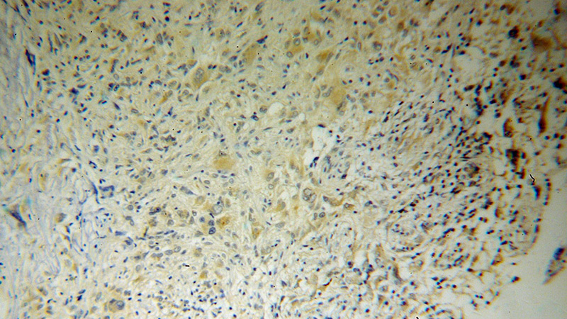 Immunohistochemical of paraffin-embedded human gliomas using Catalog No:114457(RAB6B antibody) at dilution of 1:50 (under 10x lens)