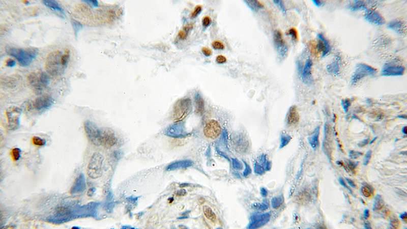 Immunohistochemical of paraffin-embedded human lung cancer using Catalog No:115056(SAMHD1 antibody) at dilution of 1:50 (under 40x lens)