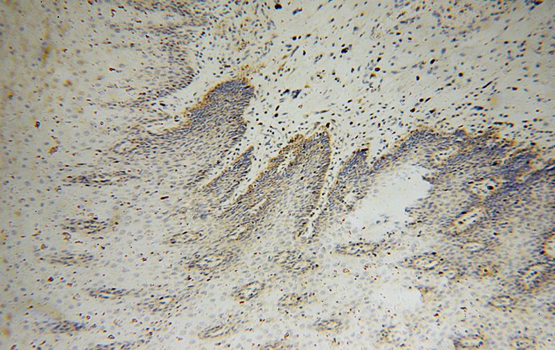 Immunohistochemical of paraffin-embedded human stomach cancer using Catalog No:108180(ARHGDIB antibody) at dilution of 1:100 (under 10x lens)
