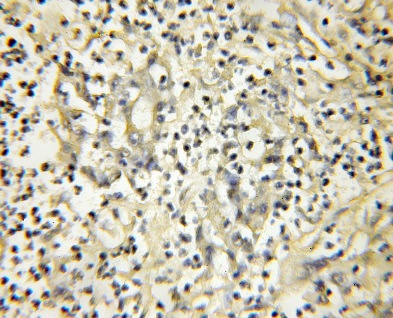 Immunohistochemical of paraffin-embedded human colon cancer using Catalog No:113455(NXT2 antibody) at dilution of 1:50 (under 10x lens)