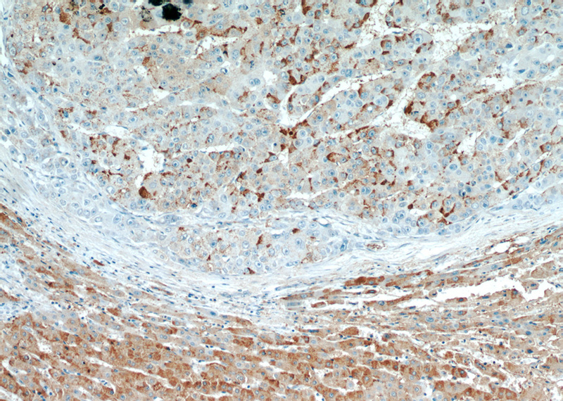 Immunohistochemical of paraffin-embedded human liver cancer using Catalog No:110300(EDC4 antibody) at dilution of 1:50 (under 10x lens)