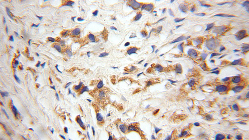 Immunohistochemical of paraffin-embedded human gliomas using Catalog No:115587(SRGAP3 antibody) at dilution of 1:100 (under 10x lens)