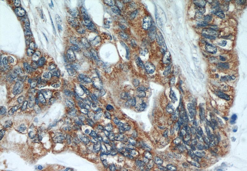 Immunohistochemical of paraffin-embedded human colon cancer using Catalog No:112767(COX2 antibody) at dilution of 1:50 (under 40x lens)