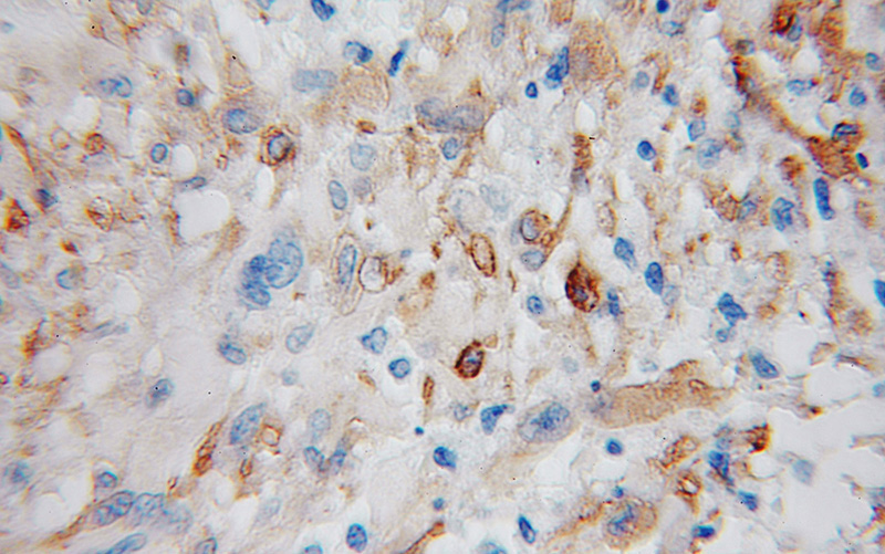 Immunohistochemical of paraffin-embedded human gliomas using Catalog No:110325(ENPP5 antibody) at dilution of 1:100 (under 10x lens)