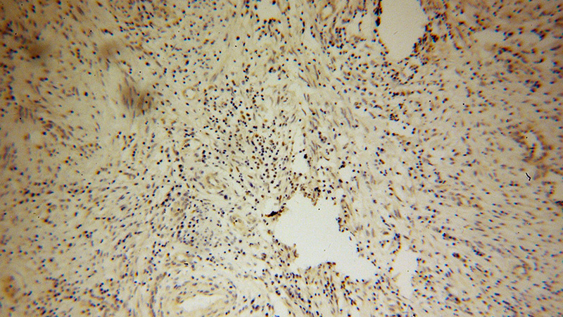 Immunohistochemical of paraffin-embedded human cervical cancer using Catalog No:114004(POLK antibody) at dilution of 1:100 (under 10x lens)