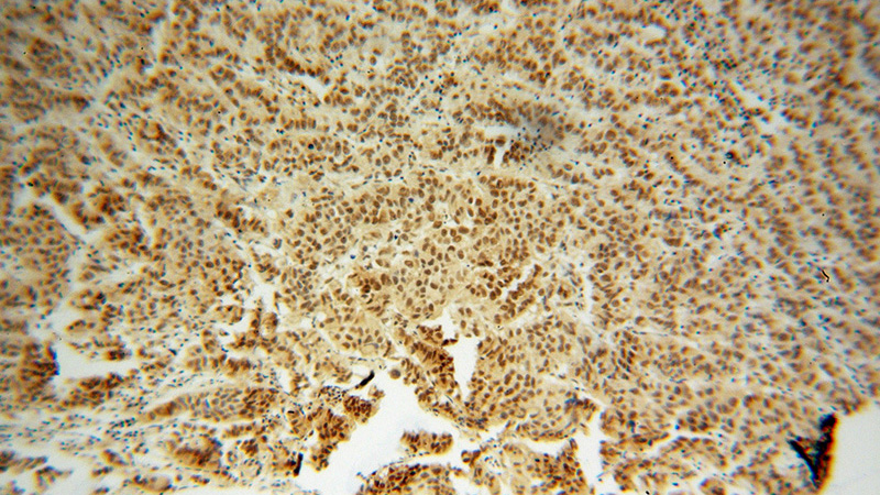 Immunohistochemical of paraffin-embedded human prostate cancer using Catalog No:113266(NR2E3 antibody) at dilution of 1:100 (under 10x lens)