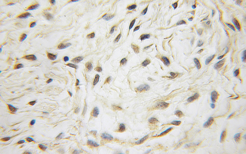 Immunohistochemical of paraffin-embedded human endometrial cancer using Catalog No:115416(SMAD2 antibody) at dilution of 1:50 (under 10x lens)