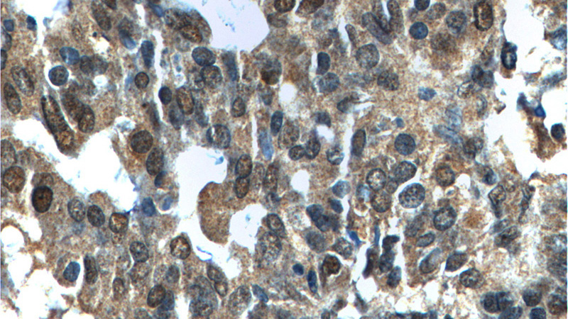 Immunohistochemistry of paraffin-embedded human ovary tumor tissue slide using Catalog No:113022(NANS Antibody) at dilution of 1:100 (under 40x lens).
