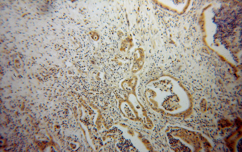 Immunohistochemical of paraffin-embedded human pancreas cancer using Catalog No:108328(ATX3,ATXN3 antibody) at dilution of 1:100 (under 10x lens)
