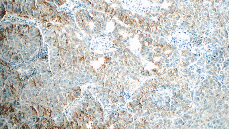 Immunohistochemistry of paraffin-embedded human lung cancer tissue slide using Catalog No:109605(CSPG4,NG2 Antibody) at dilution of 1:50 (under 10x lens)