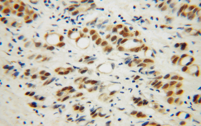 Immunohistochemical of paraffin-embedded human gliomas using Catalog No:114612(RBM4 antibody) at dilution of 1:50 (under 40x lens)