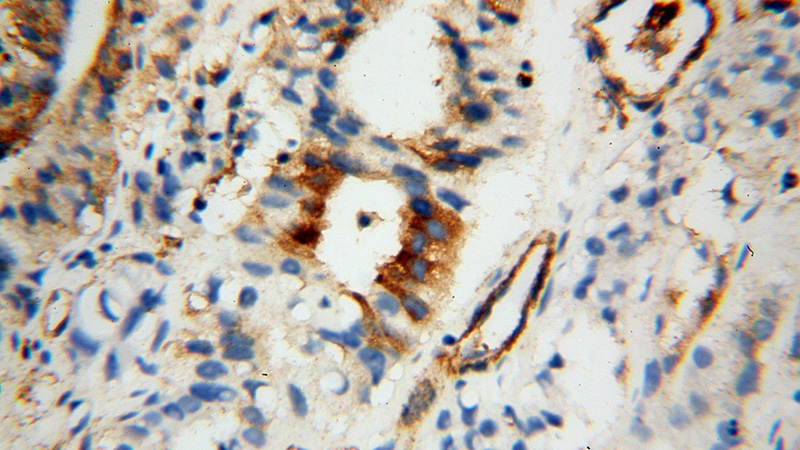 Immunohistochemical of paraffin-embedded human gliomas using Catalog No:109875(DBC1 antibody) at dilution of 1:50 (under 40x lens)