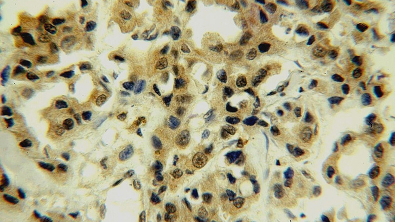 Immunohistochemical of paraffin-embedded human breast cancer using Catalog No:115750(SURVIVIN-Specific antibody) at dilution of 1:50 (under 40x lens)