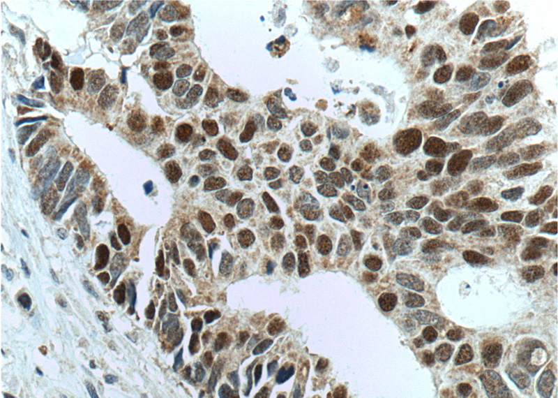 Immunohistochemistry of paraffin-embedded human colon cancer tissue slide using Catalog No:107431(MSH6 Antibody) at dilution of 1:800 (under 40x lens). heat mediated antigen retrieved with Tris-EDTA buffer(pH9).