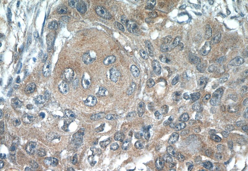 Immunohistochemistry of paraffin-embedded human lung cancer tissue slide using Catalog No:107688(ACP1 Antibody) at dilution of 1:50 (under 40x lens)