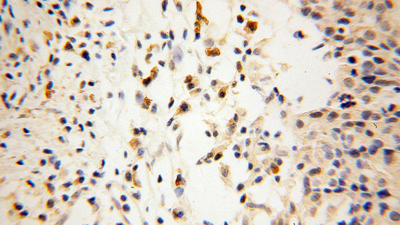 Immunohistochemical of paraffin-embedded human ovary tumor using Catalog No:116493(TULP3 antibody) at dilution of 1:100 (under 40x lens)