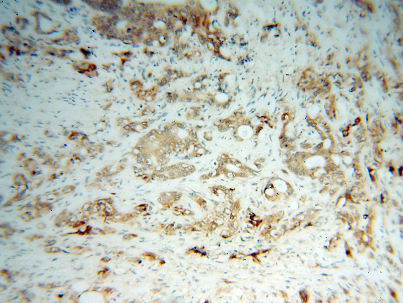 Immunohistochemical of paraffin-embedded human colon cancer using Catalog No:109193(CES2 antibody) at dilution of 1:100 (under 10x lens)