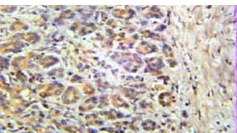 Immunohistochemical of paraffin-embedded human breast cancer using Catalog No:117073(AURKA antibody) at dilution of 1:10 (under 25x lens)