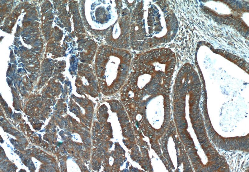 Immunohistochemistry of paraffin-embedded human colon cancer tissue slide using Catalog No:110637(FGFBP1 Antibody) at dilution of 1:50 (under 10x lens)