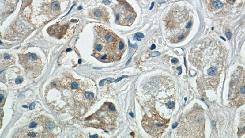 Immunohistochemistry of paraffin-embedded human breast cancer slide using Catalog No:108244(ARF3 Antibody) at dilution of 1:50 (under 40x lens)