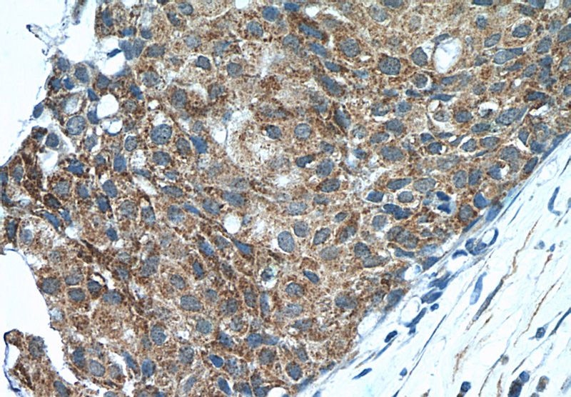 Immunohistochemistry of paraffin-embedded human breast cancer tissue slide using Catalog No:115271(SHE Antibody) at dilution of 1:50 (under 40x lens)