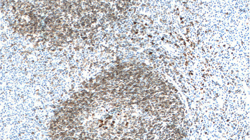 Immunohistochemistry of paraffin-embedded human tonsillitis tissue slide using Catalog No:109138(CD79A Antibody) at dilution of 1:200 (under 10x lens)
