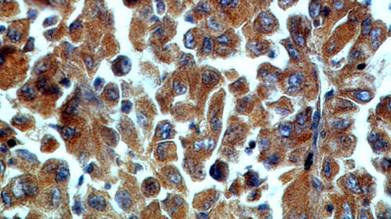 Immunohistochemical of paraffin-embedded human lung cancer using Catalog No:108798(C9orf156 antibody) at dilution of 1:50 (under 40x lens)
