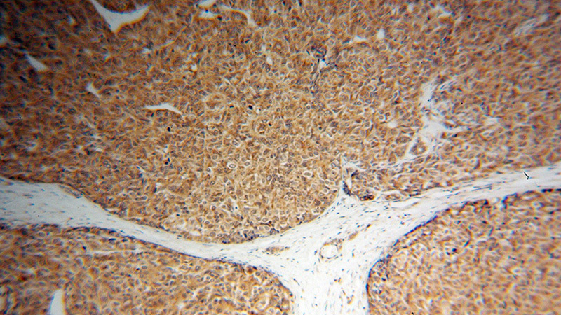 Immunohistochemical of paraffin-embedded human liver cancer using Catalog No:109725(CTNNA3 antibody) at dilution of 1:100 (under 10x lens)
