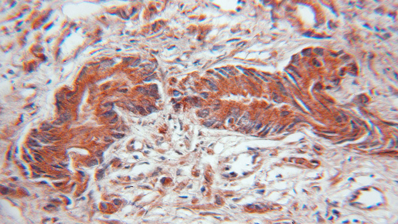 Immunohistochemical of paraffin-embedded human prostate cancer using Catalog No:110262(EIF4EBP2 antibody) at dilution of 1:100 (under 10x lens)