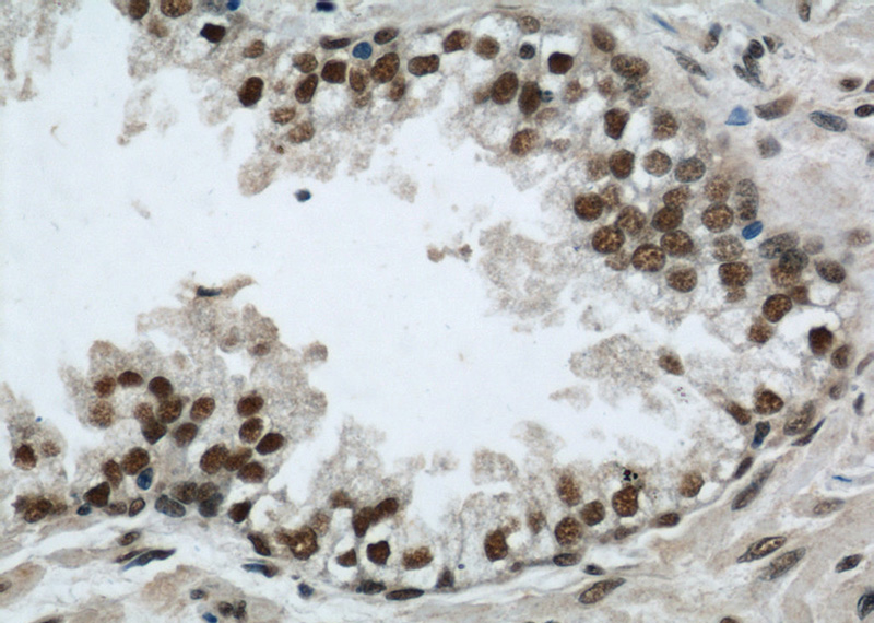 Immunohistochemistry of paraffin-embedded human prostate cancer slide using Catalog No:114259(PTBP1 Antibody) at dilution of 1:50