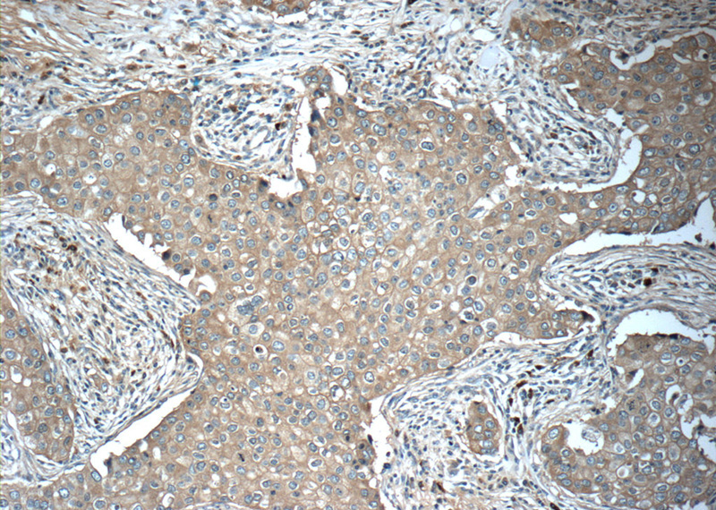 Immunohistochemistry of paraffin-embedded human breast cancer tissue slide using Catalog No:116174(TMEM199 Antibody) at dilution of 1:50 (under 10x lens)