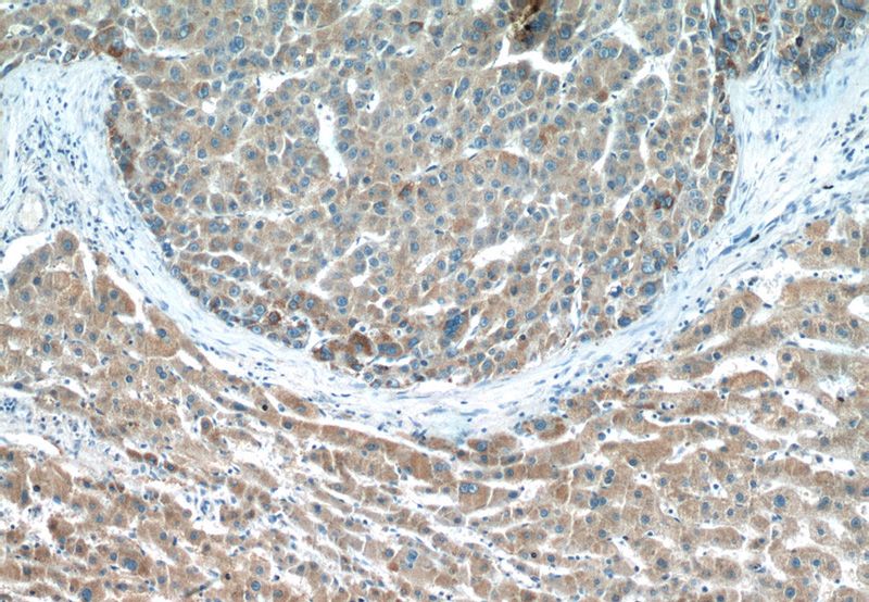 Immunohistochemistry of paraffin-embedded human liver cancer tissue slide using Catalog No:110003(DMGDH Antibody) at dilution of 1:200 (under 10x lens)