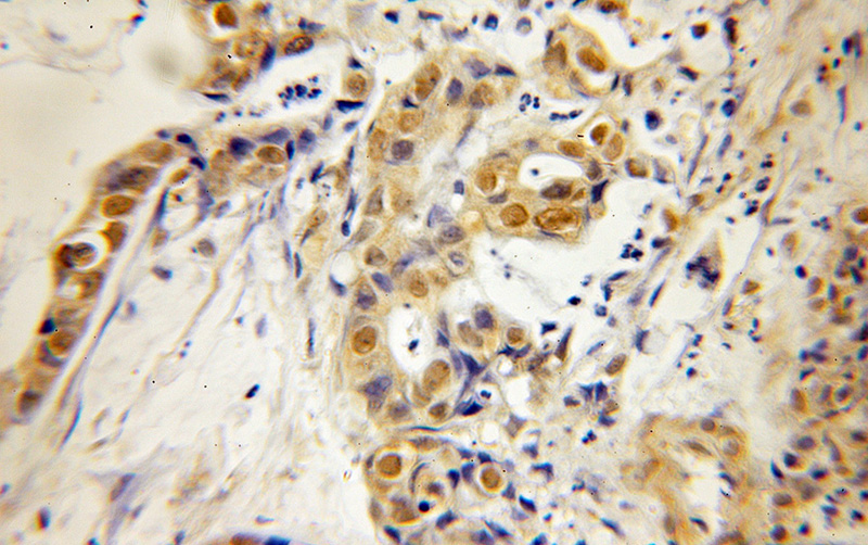 Immunohistochemical of paraffin-embedded human pancreas cancer using Catalog No:111475(HMG20A antibody) at dilution of 1:50 (under 10x lens)