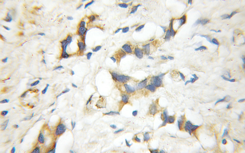 Immunohistochemical of paraffin-embedded human prostate cancer using Catalog No:114648(RGS5 antibody) at dilution of 1:50 (under 10x lens)