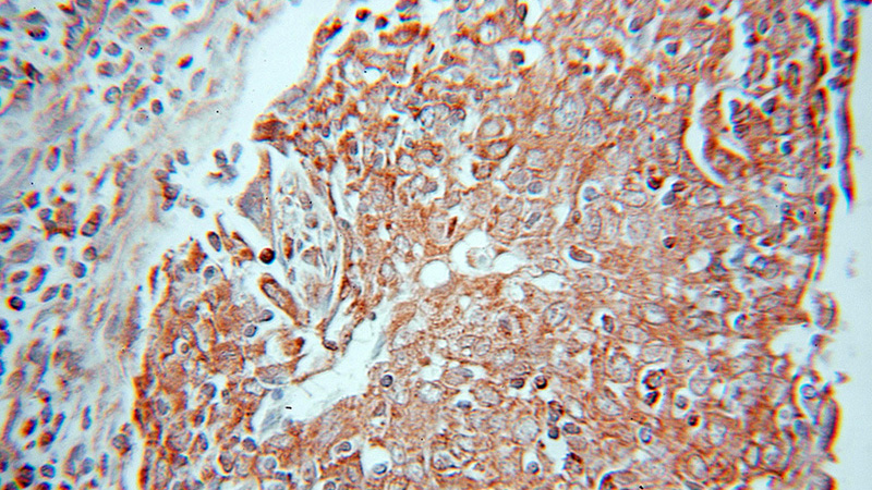 Immunohistochemical of paraffin-embedded human cervical cancer using Catalog No:107822(ABTB1 antibody) at dilution of 1:50 (under 10x lens)
